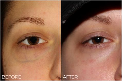 Say Goodbye to Pesky Under Eye Veins | Vein Specialists of the South Eye Veins, Visible Veins, Vein Removal, Eye Twitching, Under Eyes, Under Eye Bags, Dermal Fillers, Medical History, Eye Bags