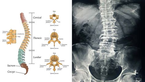 Natural Pain Killers, Types Of Cardio, Causes Of Back Pain, Spinal Alignment, Back Hurts, Spine Health, Bad Posture, Poor Posture, Good Posture