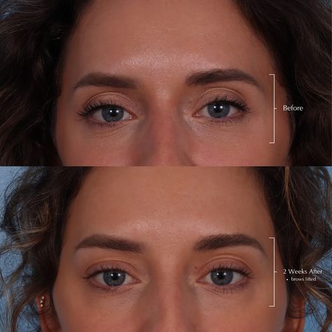 Botox In Forehead Before And After, Forehead Botox Before And After, Brow Lift Botox Eyebrows, Botox Eyebrow Lift Before And After, Brow Lift Before And After, Eyebrow Lift Botox Before And After, Botox Brow Lift Before And After, Botox Before After, Botox Eyebrow Lift