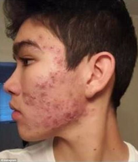 Teenage boy CLEARED severe acne with an $8 moisturizer Budget Skincare, Acne Men, Comedonal Acne, Face Acne Treatment, Acne Routine, Teenage Acne, Remedies For Acne, Acne Moisturizer, Bad Acne