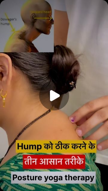 Exercise For Hunch Back, Exercise To Reduce Neck Hump, How To Reduce Neck Hump, Reduce Neck Hump Exercise, Hairstyles To Hide Neck Hump, Neck Hump Exercise, Posture Exercises Correction, Exercise For Neck Hump, Neck Hump Correction