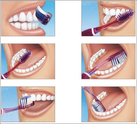 Brushing Technique, Dental Posts, Remedies For Tooth Ache, Dental Posters, Tooth Brushing, Kesehatan Gigi, Kedokteran Gigi, Sikat Gigi, Dental Life