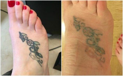 my experience with PicoSure Laser Tattoo Removal #removetattoos Lazer Removed Tattoo Before And After, Laser Tattoo Removal Before And After, Tattoo Removal Before And After, Green Tattoo Ink, Picosure Tattoo Removal, Ink Removal, Brown Tattoo Ink, Green Tattoo, Remove Tattoo