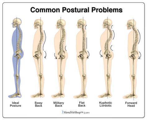 The flat back posture is essentially the opposite of the lower crossed posture. The pelvis is tilted posteriorly, which reduces the lumbar curve. The swayback posture is a combination of two adjustments at the pelvis. It combines a posterior pelvic tilt and anterior shift or “sway” of the entire pelvis. This pelvic alignment increases the distance forward of the hip from the plum line in a side view of standing posture. Bądź Fit, Upper Back Exercises, K Tape, Kinesio Taping, Back Stretches For Pain, Posture Exercises, Perfect Posture, Massage Benefits, Bad Posture