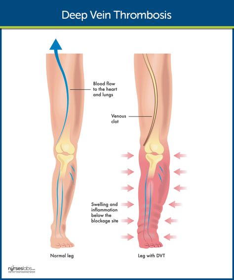 Vascular Ultrasound, Vein Thrombosis, Top 10 Home Remedies, Vascular Surgery, Medical Anatomy, Nursing Care, Medical Knowledge, Muscle Aches, Anatomy And Physiology