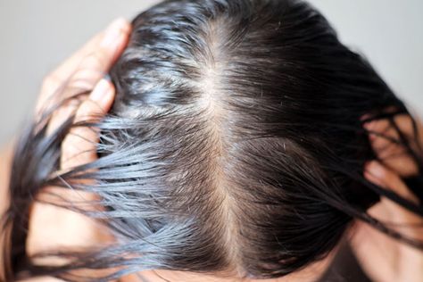 My wife was diagnosed her with telogen effluvium, which is essentially temporary hair loss caused by extreme stress on the body. The post If Your Hair Is Falling Out, You’re In Good Company appeared first on Scary Mommy. Androgenetic Alopecia, Hair Growth Cycle, New Hair Growth, Lost Hair, Normal Hair, Hair Transplant, Treated Hair, Hair Health, العناية بالشعر