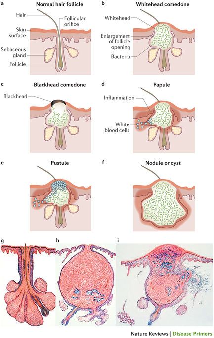 Figure 1 Skin Anatomy, Medical Esthetician, Blind Pimple, Pimples Under The Skin, Skin Facts, Skin Moles, Best Acne Products, Mary Kay Skin Care, Acne Vulgaris