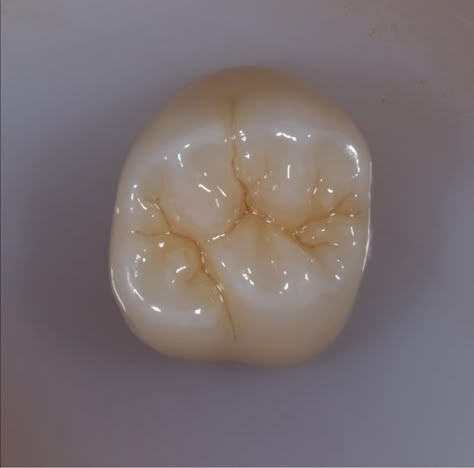 Dental Prosthesis, Dental Ceramics, Teeth Anatomy, Teeth Aesthetic, Esthetic Dentistry, Tooth Crown, Dental Photos, Dental Images, Dental Aesthetics