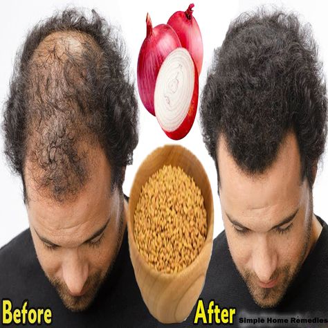 Simple Home Remedies - Make onion with rice water solution for faster hair growth and stop hair fall Onion Hair Growth, Women In China, Faster Hair Growth, Onion For Hair, Tennessee Travel, Rice Water, Water Solutions, Fast Hairstyles, Hair Growth Faster