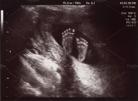 Baby Development In Womb, Baby In Womb, Baby Development Milestones, Ultrasound Sonography, Sonogram Pictures, Pregnancy Ultrasound, Creative Development, In Utero, Pregnancy Health