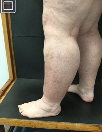 Do I Have May-Thurner Syndrome? May Thurner Syndrome, The Carolinas, Compression Stockings, Skin Discoloration, Google Search