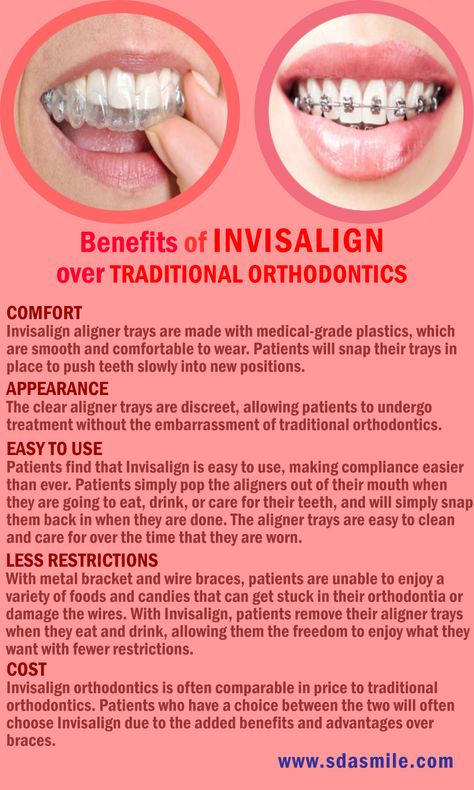 Straighten Teeth Without Braces, Dental Ads, Braces Care, Straighten Teeth, Invisalign Aligners, Invisalign Braces, Braces Tips, Getting Braces, Dental Posts