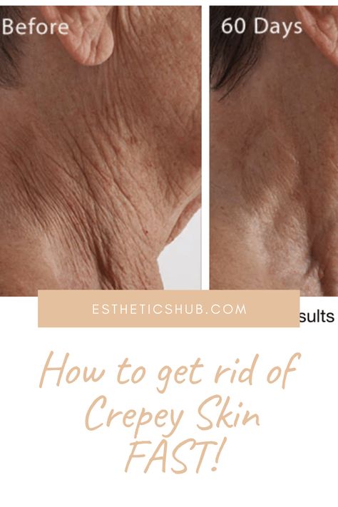 If you suffer from Crepey skin on your neck, arms or legs, you need to read this post! Creepy Skin On Arms, Crepey Neck Skin Remedies Diy, Crepe Skin Remedy How To Get Rid, How To Fix Crepey Skin, Crepe Neck Skin Remedy, How To Get Rid Of Crepey Skin Naturally, How To Get Rid Of Crepey Skin On Arms, Creepy Skin How To Get Rid Of, Best Lotion For Crepey Skin