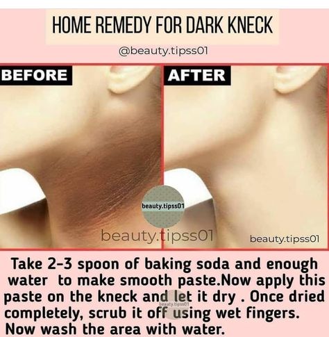 Remedy For Dark Neck, Dark Neck Remedies, Dark Neck, Diy Skin Care Routine, Serious Skin Care, Good Skin Tips, Wave Goodbye, Healthy Skin Tips, Body Hair Removal