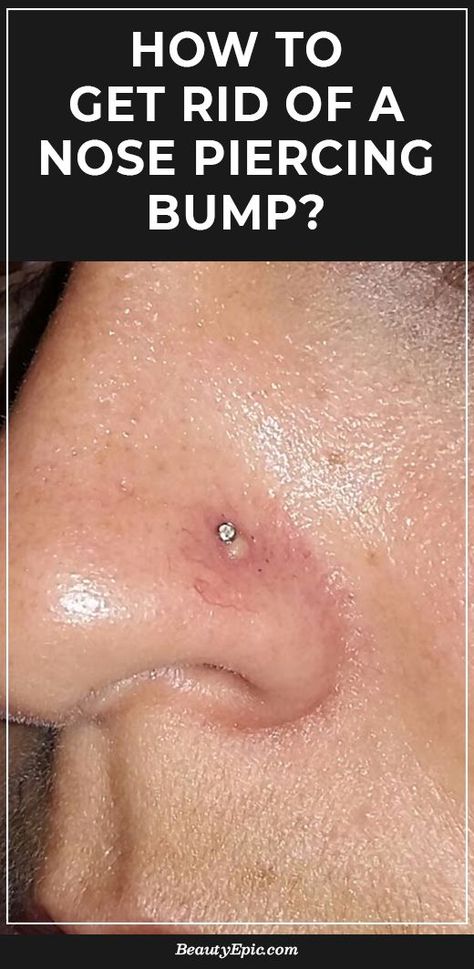 After piercing the nose, a bump appears at the site. This occurs often because of infection or allergic reactions but it can be healed. Ear Piercing Bump How To Get Rid, Pimple Under Nose, Nose Ring Bump, Getting Nose Pierced, Nose Piercing Infection, Symptoms Of Gluten Intolerance, Nose Infection, Nose Piercing Care, Nose Piercing Healing