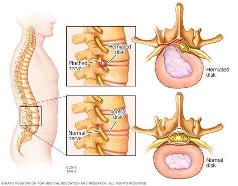 Herniated disk - Symptoms and causes - Mayo Clinic Anaerobic Respiration, Emt Study, Disc Herniation, Sciatica Symptoms, Intervertebral Disc, Chronic Lower Back Pain, Disk Herniation, Spinal Nerve, Pinched Nerve