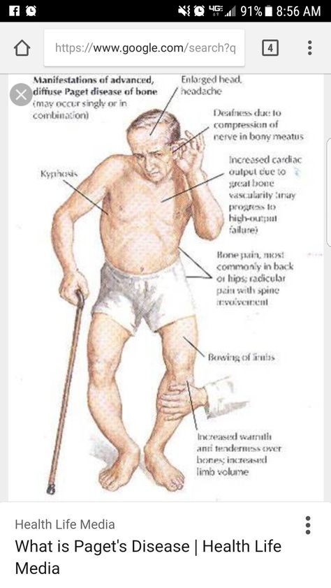 Paget's disease of the bone Nursing Musculoskeletal, Musculoskeletal Nursing, Musculoskeletal Disorders, Registered Nurse School, Crazy Nurse, Pagets Disease, Emt Study, Paramedic School, Nurse Practitioner School