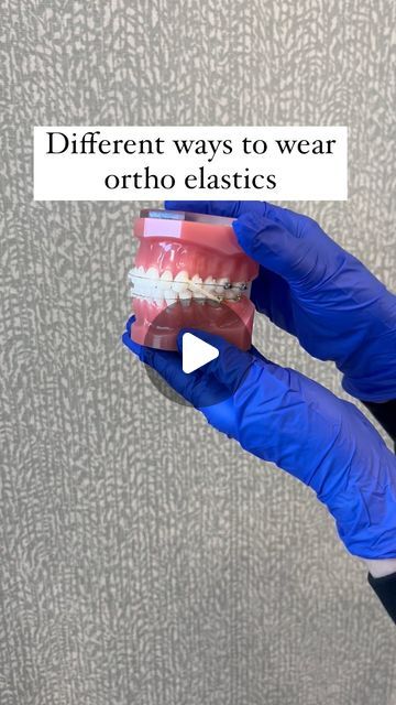 Different ways to wear your orthodontic elastics and how they help to move your teeth Braces With Rubber Bands, Fix Overbite, Orthodontics Teeth, Braces Rubber Bands, Braces Bands, Braces Elastics, Diy Elastic, Getting Braces, Straight Teeth