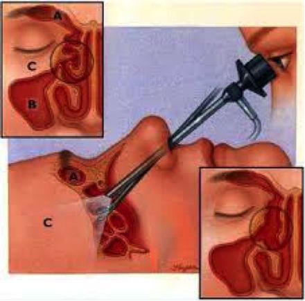 This outpatient minimally invasive sinus surgery does not require any incisions on the face, yet efficiently and effectively targets diseased areas within the nose and sinuses. None of the healthy tissues within the sinus cavities are disturbed, but rather only the diseased or blocked areas are widely opened to allow proper drainage of the sinus … Continue reading Functional Endoscopic Sinus Surgery (FESS) → Endoscopy Procedure, Nasal Polyps, Blocked Sinuses, Sinus Remedies, Paranasal Sinuses, Sinus Cavities, Fitness Healthy Lifestyle, One Step Forward, Allergy Remedies