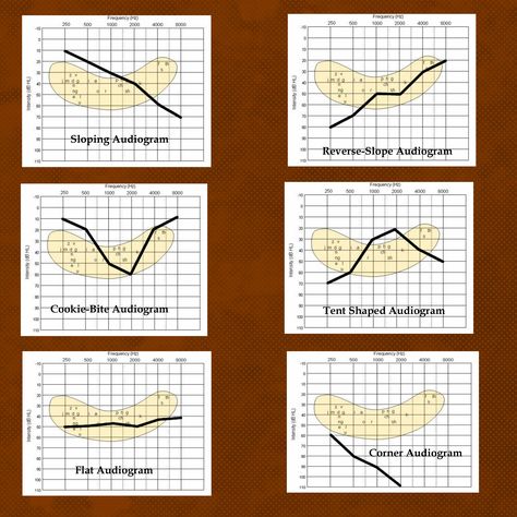 The Best Hearing Loss Simulations: Understanding Audiograms and the Impact of the Speech Banana Audiology Student, Ear Ringing, Cochlear Implants, Speech And Hearing, Deaf Education, Auditory Processing, Deaf Culture, Hearing Health, Cochlear Implant