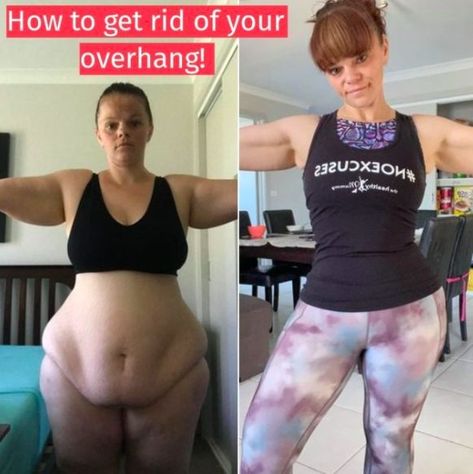 You don’t have to do endless crunches to get rid of your tummy overhang! Belinda is PROOF. Belly Overhang Get Rid Of, How To Shrink Hanging Belly, How To Fix Apron Belly, Apron Stomach Workout, Apron Stomach How To Get Rid, How To Get Rid Of Belly Overhang, How To Get Rid Of Big Stomach, Overhang Belly Exercise, Apron Exercises