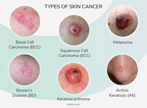 Skin Disease Pictures, Cancerous Moles, Skin Mapping, Basal Cell, Skin Moles, Squamous Cell, Types Of Skin, Breast Health, Skin Disorders