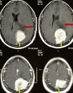 Benign Brain Tumors - Non-Cancerous Tumor - Brain-Surgery.com Brain Tumour Ct Scan, Brain Radiology, Brain Surgery Recovery, Mri Brain, Computed Tomography, Brain Tumour, Brain Tumors, Brain Images, Cerebrospinal Fluid