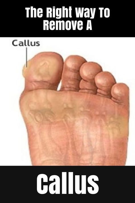 The Right Way To Remove A Callus Callus Remover Diy, Callous Remover, Best Callus Remover, Nail Problems, Tongue Health, Callus Remover, Natural Cough Remedies, Callus Removal, Body Detox