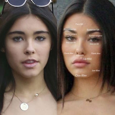 Madison Beer plastic surgery surgery before and after, natural face without makeup and surgery. 2020,2021,2022,2023 plastic surgery analysis breakdown Eyebrow Lift Surgery, Filler Face, Botox Lip Flip, Eye Lift Surgery, Foxy Eye, Lip Flip, Lip Surgery, Cheek Implants, Chin Filler