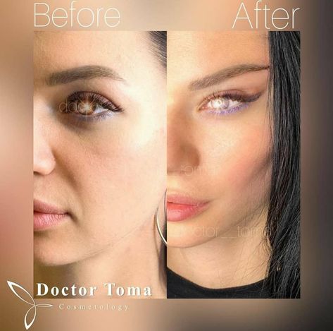 Fox Eye Lift, Jawline And Cheekbones, Non Surgical Facelift, Facial Fillers, Fox Eyes, Brow Lift, Eye Lift, Cosmetology, Her Hair