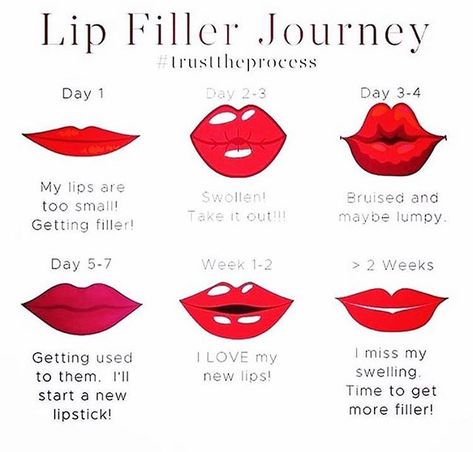 Lip Filler Swelling, Botox Quotes, Aesthetic Injector, Juvederm Lips, Juvederm Voluma, Face Fillers, Cosmetic Injectables, Facial Aesthetics, Lip Filler