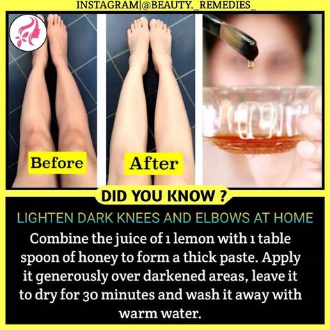 Dark Knees And Elbows, Dark Knees, Skin And Hair Clinic, Skin Face Mask, Clear Healthy Skin, Natural Skin Care Remedies, Diy Skin Care Recipes, A Better You, Perfect Skin Care Routine