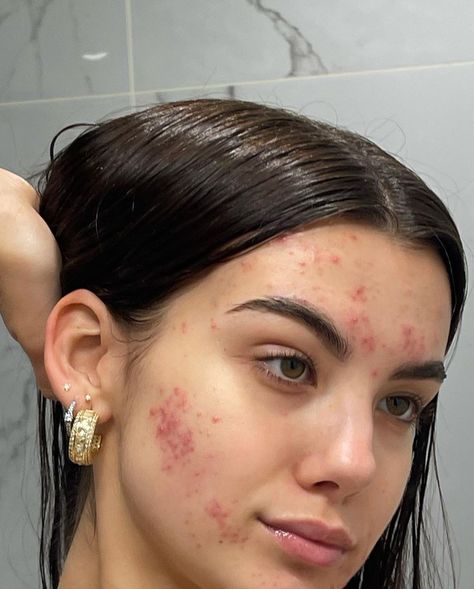 Girl With Acne, Face Imperfections, Lemon Face, Best Dark Spot Corrector, Lemon Face Mask, Real Bodies, Bare Beauty, Facial Skin Care Routine, Love Your Skin