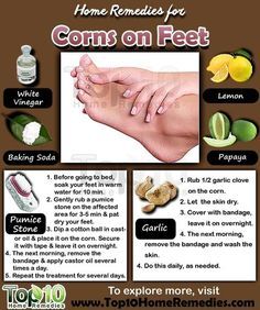 Prev post1 of 3Next Corns are small circles of hard, thickened skin that develop when the skin is exposed to excessive pressure or friction. Corns most often develop on the feet, especially on the tops and sides of the toes, soles of your feet and even between the toes. They can also develop on other Get Rid Of Corns, Corn Removal, Nail Remedies, Lemon Vinegar, Top 10 Home Remedies, Nail Fungus, Nail Health, Foot Care, Health Remedies