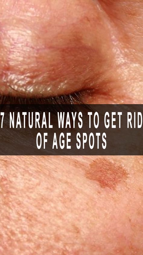 7 Natural Ways to Get Rid of Age Spots Skin Care In Winter, Get Rid Of Age Spots, Age Spot Remedies, Skin Firming Cream, Black Spots On Face, Get Rid Of Spots, Age Spot Removal, Extreme Cold Weather, Hydrate Your Skin