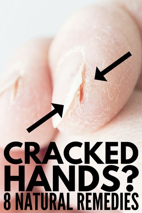 Cracked Hands Remedy, Cracked Fingertips, Dry Hands Remedy, Cracked Fingers, Extremely Dry Hands, Dry Cracked Hands, Cracked Hands, Rough Hands, Skin Care Routine For 20s