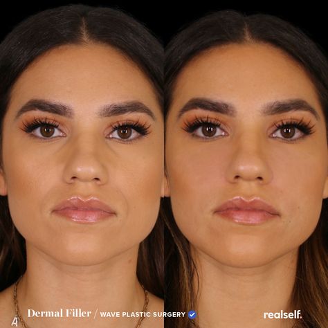 93% of people on RealSelf say it's Worth It. Nasolabial Fold Filler, Under Eye Hollows, Under Eye Fillers, Face Fillers, Hyaluronic Acid Fillers, Tear Trough, Botox Face, Cheek Fillers, Beauty Procedures