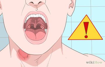 How to Get Rid of Sore Tonsils (with Pictures) - wikiHow Mucus In Throat, Heal Sore Throat, Burning Throat, Getting Rid Of Mucus, Mucus Relief, Getting Rid Of Phlegm, Scratchy Throat, Throat Remedies, Sore Throat Remedies