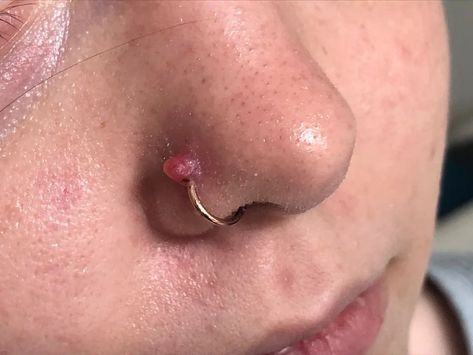 7 Ways to Get Rid of a Nose Piercing Bump For Good Nose Ring Bump Tea Tree Oil, Keloids Nose Piercing, Infected Nose Ring, Nose Ring Bump, Nose Piercing Infection, Nose Bump, New Nose Piercing, Getting A Nose Piercing, Infected Ear Piercing