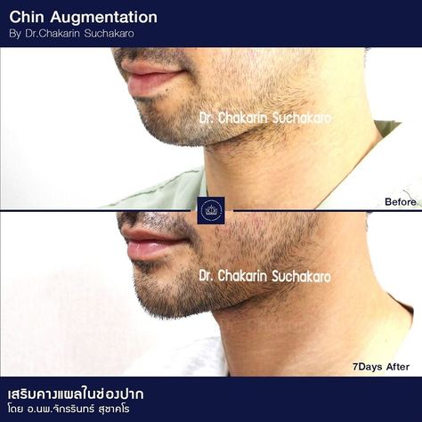 Restore your facial harmony with Chin Augmentation by Dr.Chakarin Suchakaro! By strengthening the chin profile, Dr.C can help bring balance and proportion to the rest of your face while creating a stronger jawline and more youthful facial contour thus restoring your facial harmony. Stronger Jawline, Facial Harmony, Chin Augmentation, Strong Jawline, Surgery, Facial, Bring It On