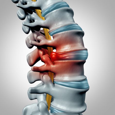 Lumbar Disc, Intervertebral Disc, Bulging Disc, Disk Herniation, Nerve Health, Sciatic Nerve Pain, Sciatica Pain, Sciatic Nerve, Chiropractic Care