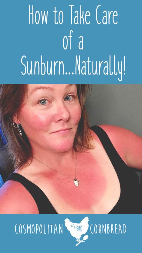 Bath For Sunburn Relief, Remedies For Sunburn Skin, Essential Oil For Sunburn Relief, Homemade Sunburn Relief, What To Put On Sunburn Skin, What Helps With Sunburns, Diy Sunburn Remedies, After Sunburn Care, Tips For Sunburn