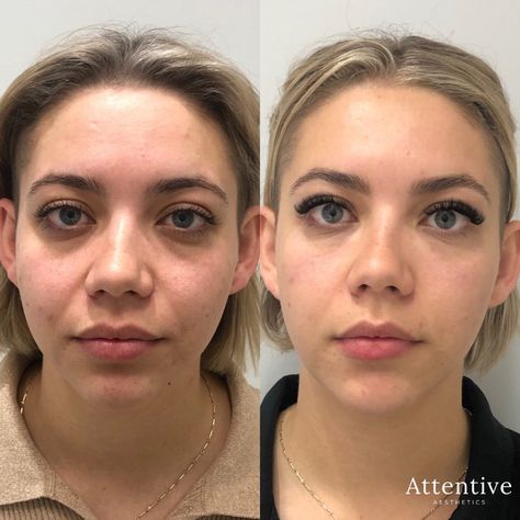 Under Eye Fillers Perth | Tear Trough Filler Perth | Attentive Aesthetics | Cosmetic Clinic Perth Tear Through Eye Filler, Tear Trough Filler Before After, Eye Dermal, Tear Trough Filler, Under Eye Filler, Eye Filler, Under Eye Hollows, Under Eye Fillers, Tear Trough