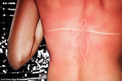 Humans do NOT come from Earth - and sunburn, bad backs and pain during labour prove it, expert claims Sunburn Blisters, Sciatic Nerve Stretches, Healthy Tan, Stretches For Runners, Bad Sunburn, Sunburn Skin, Sunburn Remedies, Sciatica Exercises, Organic Sunscreen