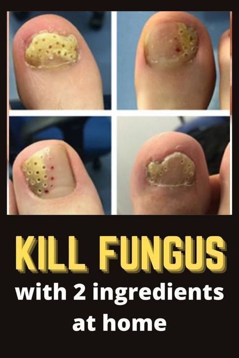 Kill toenail fungus with simple trick!!#killsnail #treatmentfungus #nailfungus #toenailfungus #fungus #fungustretment Toenail Health, Toenail Fungal Infection, Cuadros Diy, 2 Ingredient Recipes, Toenail Fungus Remedies, Nail Infection, Fungal Nail, Toenail Fungus, Fungal Infection