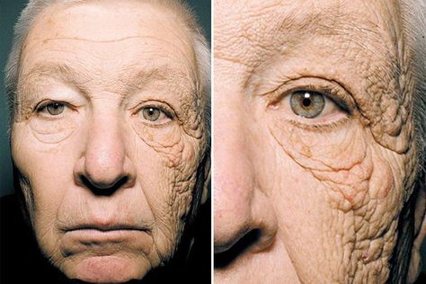 THE face of an elderly truck driver is a shocking demonstration of the dangers of sun damage to the skin. Coola Sunscreen, Healthy Tan, Face Sun, Facing The Sun, Body Fluid, Sun Exposure, Sun Damage, Side Window, Sagging Skin