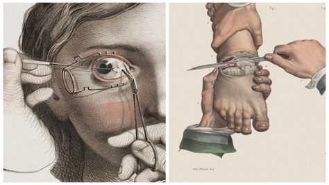 Morbidly Beautiful Illustrations Reveal The Horror Of Surgery In The 15th–19th Centuries Humphry Davy, Surgery Art, Medical Pictures, Surgical Procedures, Human Anatomy Art, Vintage Medical, Design Technology, Inventors, Medical Illustration