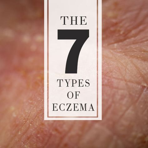 What are the different forms of Eczema? Skin Cream Anti Aging, Snoring Remedies, Skin Allergies, Anti Aging Skin Products, Different Types, Skin, Los Angeles