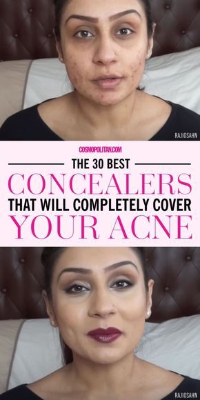 Best Concealer For Acne, Concealer Products, Revolution Skincare, Best Concealers, Acne Makeup, Best Concealer, Acne Problem, Cystic Acne, Acne Remedies