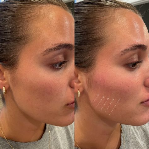 𝑨 𝒍𝒐𝒐𝒌 𝒀𝑶𝑼'𝑳𝑳 𝑳𝑶𝑽𝑬! Loss of check definition, or CONTOUR, can make you look tired or drained. NOT ANYMORE - release your inner radiance with @Restylaneusa CONTOUR. Filler For Cheek Enhancement ✨ Flexible Movement ✨ Natural-looking results ✨ Long Lasting Cheek Fillers Round Face, Natural Fillers For Face, Mid Cheek Filler, Cheek Filler Before And After, Face Contouring Fillers, Cheek Fillers Before And After Face, Cheek Lift, Under Eye Fillers, Face Fillers